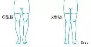 婴儿o型腿怎么矫正最有效的方法,o型腿怎么通过运动矫正