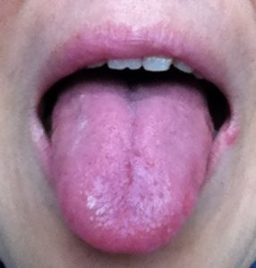 舌头有突起是什么病,舌头有这些表现或是疾病征兆