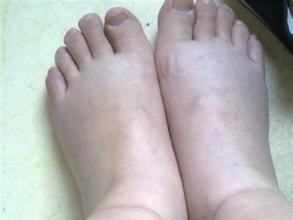 孕妇脚肿是怎么缓解呢,孕妇脚肿怎么办最有效的方法