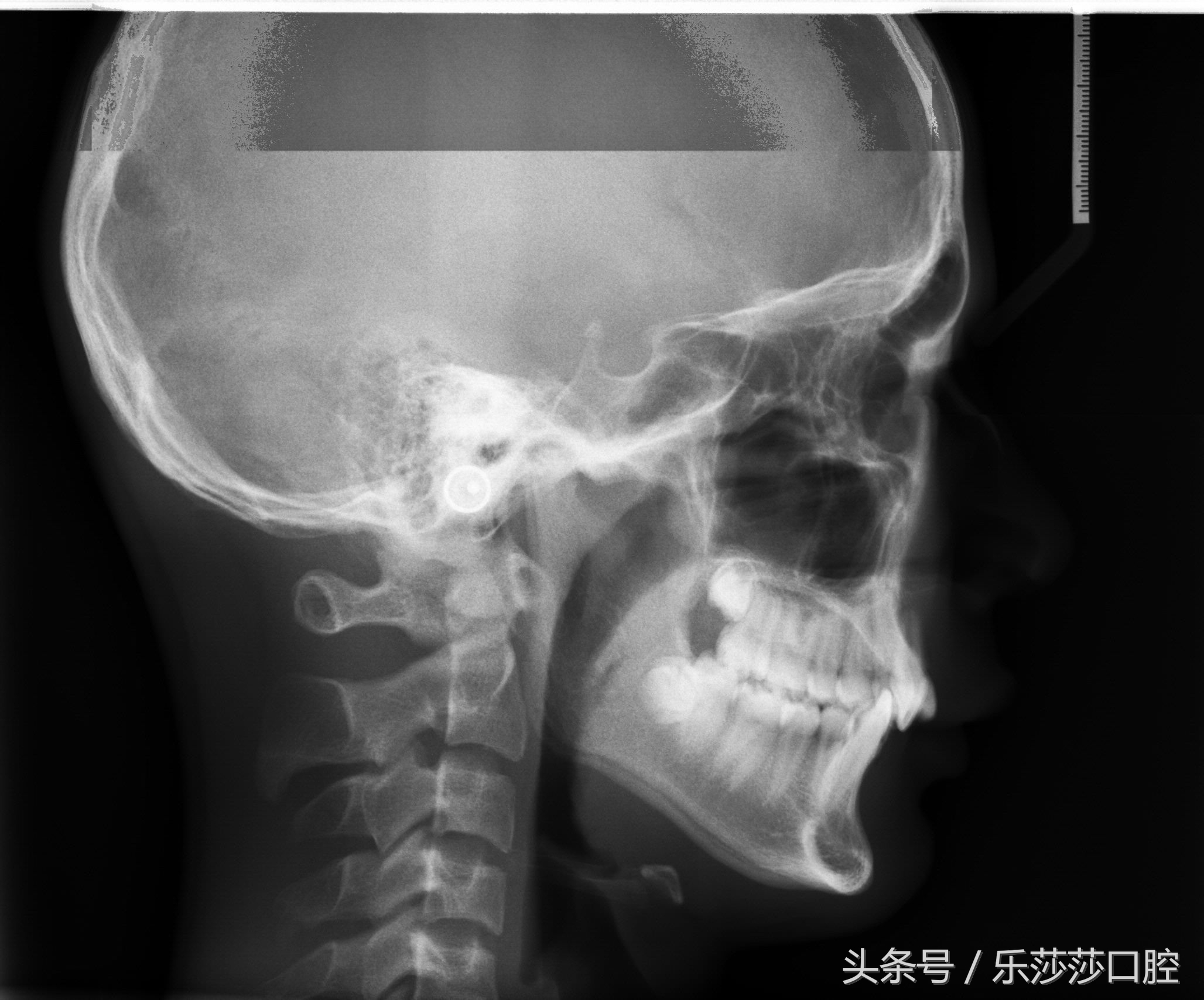 到底适不适合整牙,整牙到底有多可怕