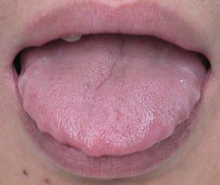 舌头有突起是什么病,舌头有这些表现或是疾病征兆