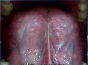 舌头有突起是什么病,舌头有这些表现或是疾病征兆