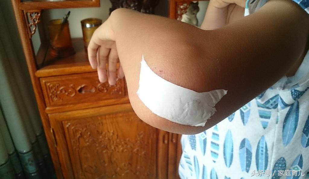 宝宝擦伤破皮出血需要打破伤风吗,宝宝蹭破皮流血怎么处理