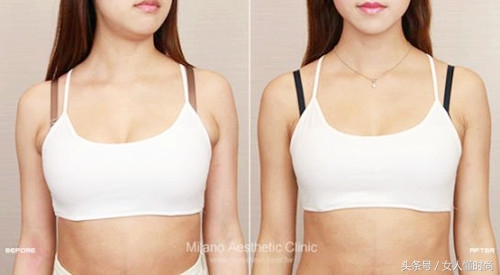 副乳消除贴真的能消除副乳吗,副乳怎么消除最快最有效