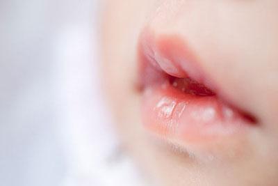很多婴儿小孩长鹅口疮，父母却都不知道，所有鹅口疮知识全在这里