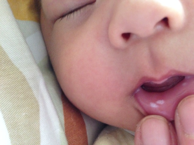 很多婴儿小孩长鹅口疮，父母却都不知道，所有鹅口疮知识全在这里