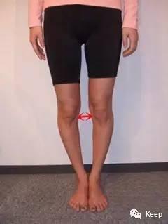 婴儿o型腿怎么矫正最有效的方法,o型腿怎么通过运动矫正