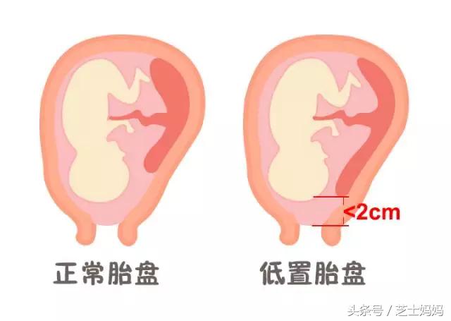 让你卧床不能起的前置胎盘，到底是咋回事|孕产笔记