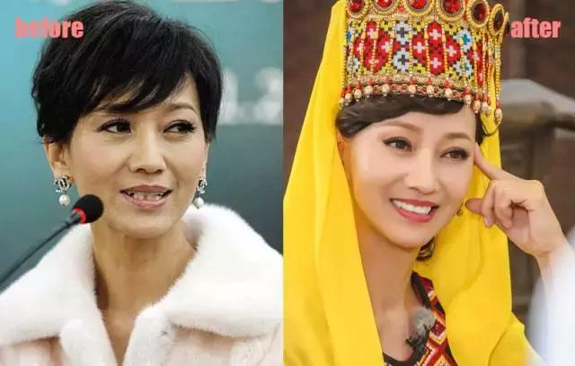整牙刘涛,整牙改变脸型杨幂