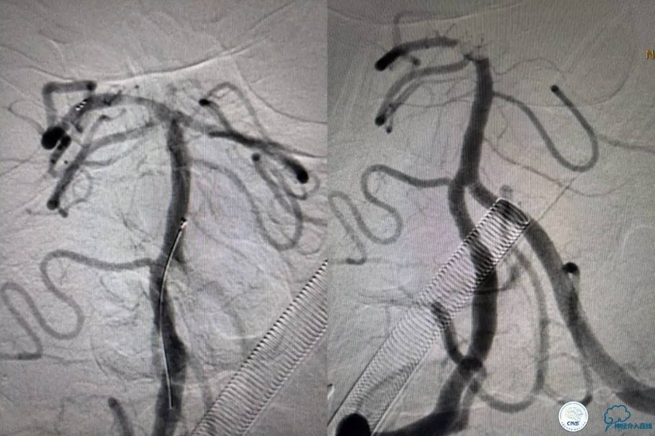 一例急性基底动脉尖综合征患者的支架取栓治疗