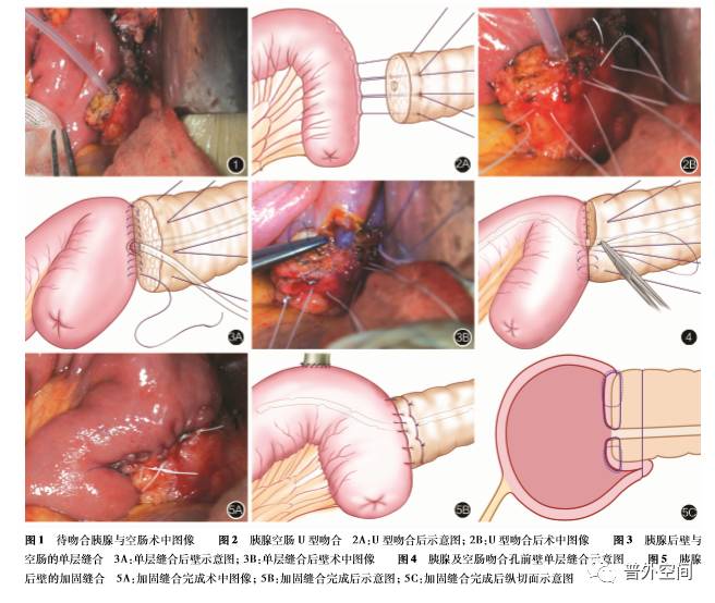胰腺后壁加固胰肠一层半吻合在胰十二指肠切除术中的应用价值