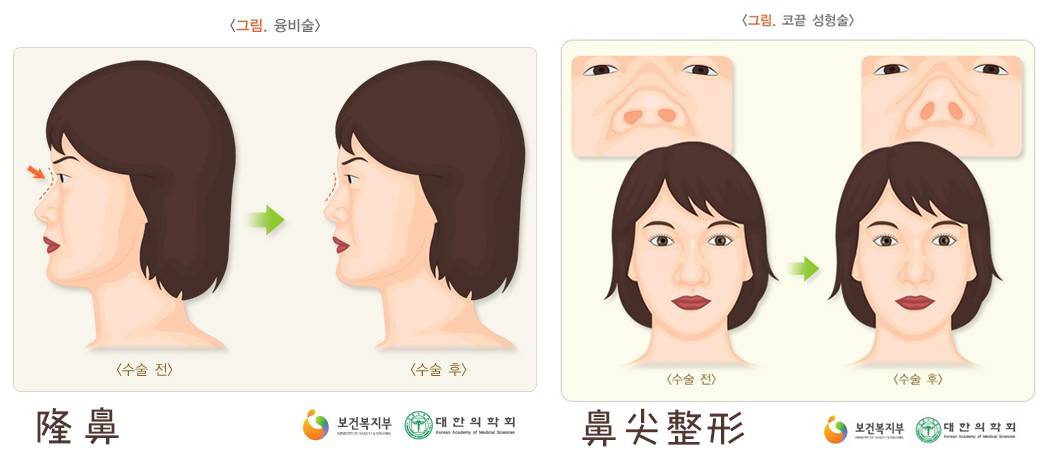 双眼皮手术韩式整形,韩国医生做幽灵手术