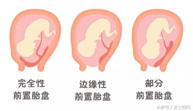 让你卧床不能起的前置胎盘，到底是咋回事|孕产笔记