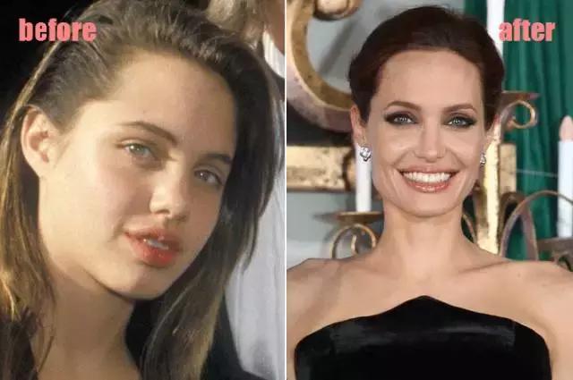 整牙刘涛,整牙改变脸型杨幂