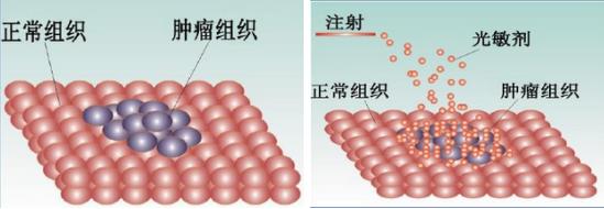根治性放疗能消灭肿瘤吗,根治性放疗能彻底杀灭癌细胞吗