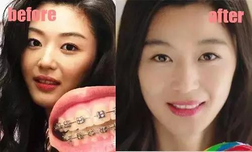 整牙刘涛,整牙改变脸型杨幂