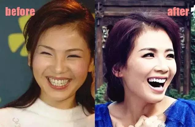 整牙刘涛,整牙改变脸型杨幂