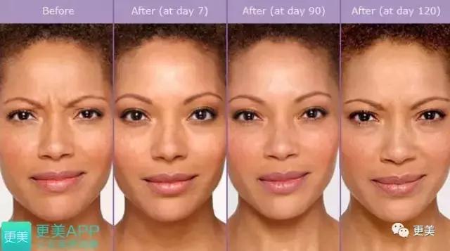 朋友圈肉毒素代购，白毒粉毒绿毒蓝毒到底靠不靠谱？