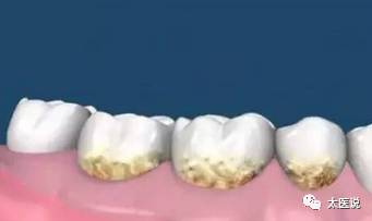 蛀牙牙疼松动疼痛难忍能拔掉吗,蛀牙牙疼刷牙能缓解吗