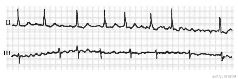 郭雅卿心电图讲解全集,郭雅卿血汗管视频课