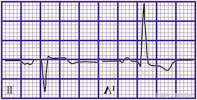 郭雅卿心电图讲解全集,郭雅卿血汗管视频课