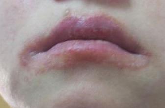 小孩嘴唇干裂是什么原因引起的,嘴唇干裂起皮鼻孔也干是什么原因