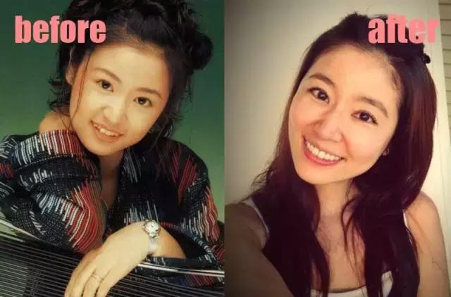 整牙刘涛,整牙改变脸型杨幂