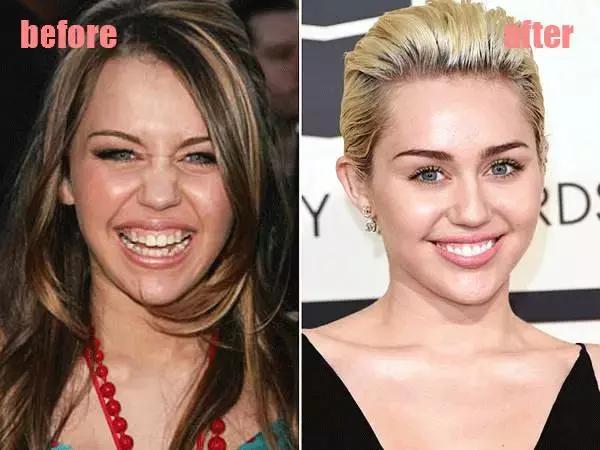 整牙刘涛,整牙改变脸型杨幂