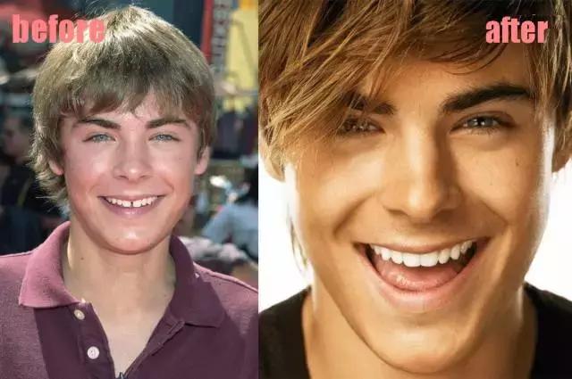 整牙刘涛,整牙改变脸型杨幂