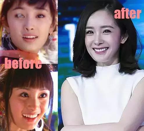整牙刘涛,整牙改变脸型杨幂