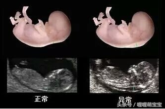 产前全面产检检查什么,孕妇早期b超检查怎么看图像