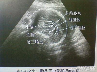 产前全面产检检查什么,孕妇早期b超检查怎么看图像