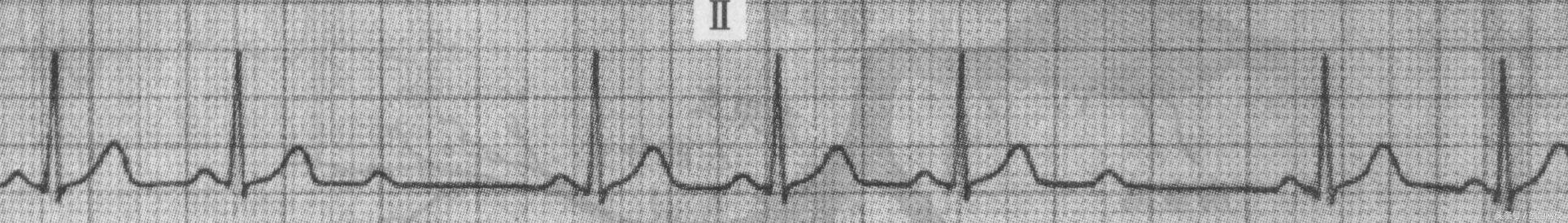 郭雅卿心电图讲解全集,郭雅卿血汗管视频课
