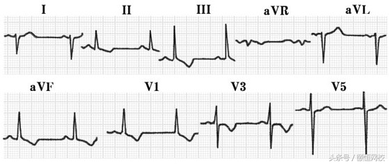 郭雅卿心电图讲解全集,郭雅卿血汗管视频课