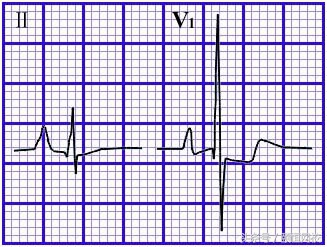 郭雅卿心电图讲解全集,郭雅卿血汗管视频课