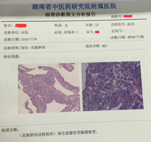 低位直肠癌保肛冷冻治疗多少费用,低位直肠癌患者保肛后存活率