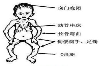 维生素d缺乏性佝偻病的护理诊断,导致维生素d缺乏性佝偻病的原因