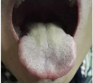 舌苔黄腻厚手心热低烧,舌苔白腻低烧不退