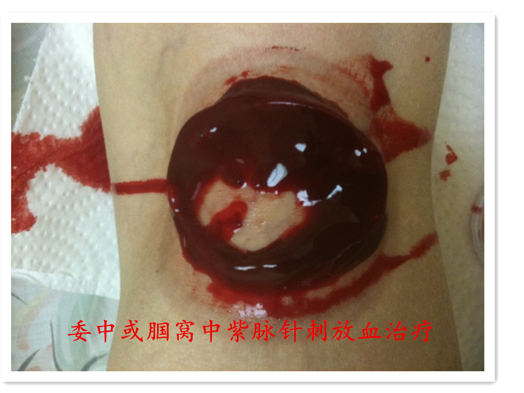 脚踝扭伤肿痛针刺放血,急性腰扭伤经方