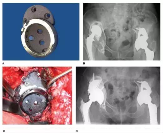 髋臼底严重骨缺损怎么翻修,髋臼骨缺损2厘米能愈合吗