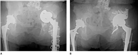 髋臼底严重骨缺损怎么翻修,髋臼骨缺损2厘米能愈合吗
