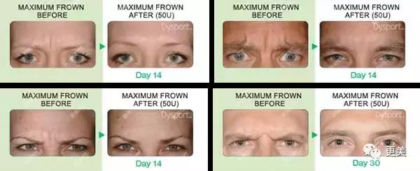 朋友圈肉毒素代购，白毒粉毒绿毒蓝毒到底靠不靠谱？