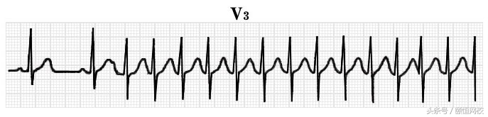 郭雅卿心电图讲解全集,郭雅卿血汗管视频课