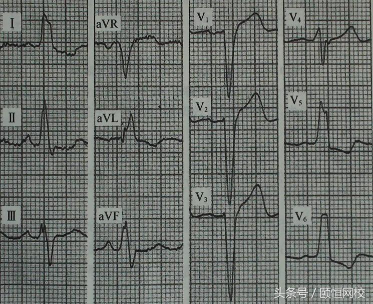 郭雅卿心电图讲解全集,郭雅卿血汗管视频课
