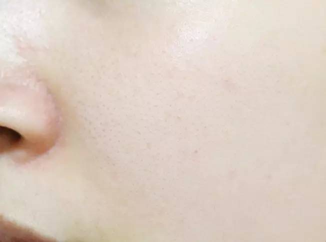 双眼皮手术韩式整形,韩国医生做幽灵手术