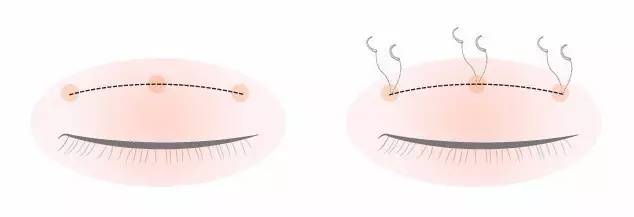 双眼皮手术韩式整形,韩国医生做幽灵手术