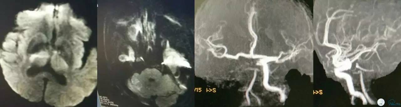 一例急性基底动脉尖综合征患者的支架取栓治疗