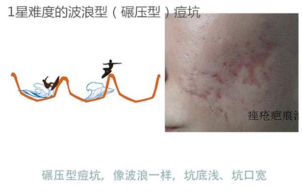 微针治痘坑涂碘伏,微针对深痘坑有效吗