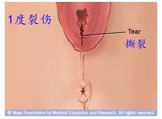 第67课：会阴侧切与撕裂