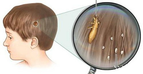 小孩头发长满了虱子,老人小孩头上长满虱子原因